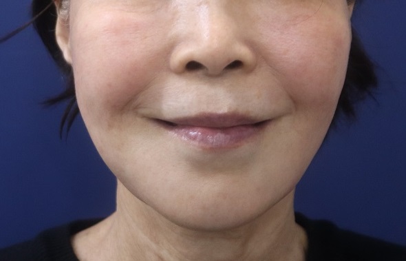 고나영 원장 어머니 마리오네트 치료: 입가 주름, 입술 주름, 심술보, 입꼬리 치료 - 강서구 마곡, 발산역 피부과전문의 ...