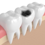 충치 생성 메커니즘 - 법랑질 손상, 치아 부식 원리