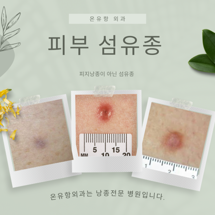 수원 화성 피지낭종 피부섬유종 수술은 못한다고 해서 온유항외과에서 수술했어요! : 네이버 블로그
