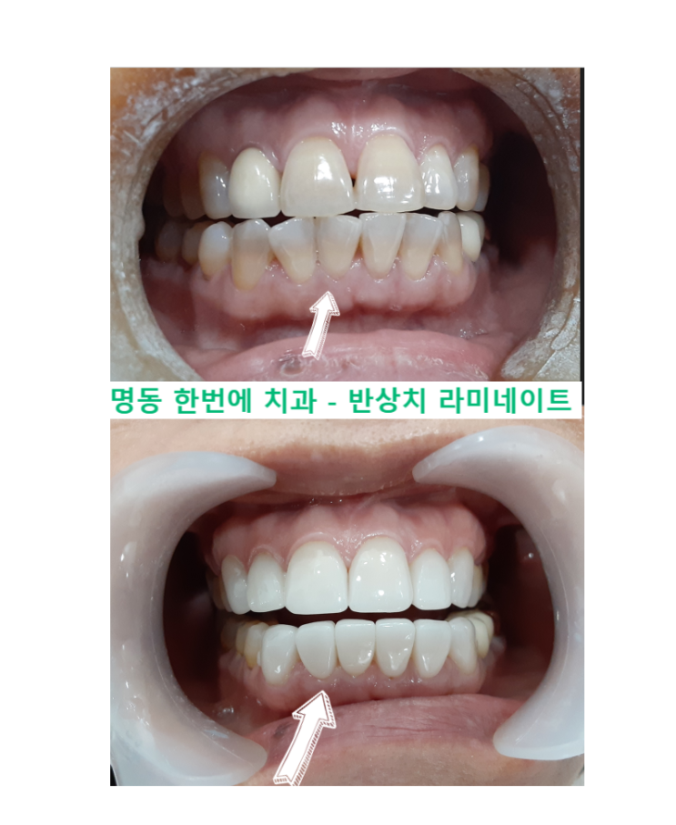 앞니갈색줄, 반상치전문치과에서 미니쉘라미네이트한 후기- 명동한번에치과 : 네이버 블로그