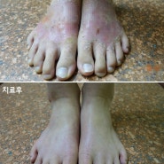 발등 가려움 심한 피부염 형태로 악화된 사례