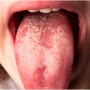 양성 이동성 설염, 지도설(geographic tongue)의 원인 및 치료