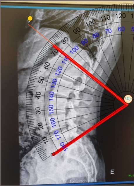허리가 잘 다치는 이유는? 골반 전방경사형 체형, 요추 전만각(Lumbar lordosis angle, LL), 척추측만 ...