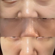 눈밑지방재배치 + 미세 지방이식 수술 후기 일주일 변화과정