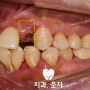 사고로 다친 전치부 앞니 부분교정까지 생각한 이유