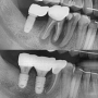 치주과전문의) 흔들리는 치아 발치 후 임플란트와 임플란트 식립위치의 중요성으로 재수술을 동시에 진행한사례 / 치료시기를 놓치면
