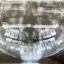 유아 치과 진료 꿀팁 & 파노라마 엑스레이 찍기 & 소아치과 추천