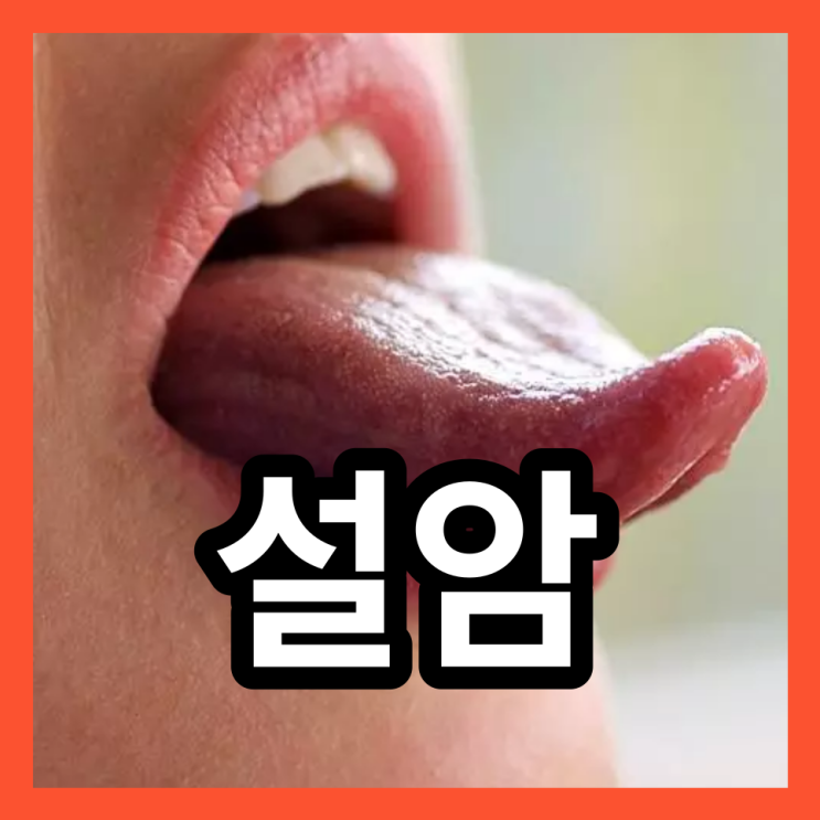 설암 초기 증상과 원인 및 설암 수술 치료방법 : 네이버 블로그