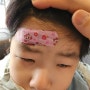 아기얼굴 이마상처 긴급 봉합수술 후기::서울마더스성형외과