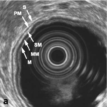 Upper GI - Gastritis, Gastric ulcer, GI bleeding : 네이버 블로그