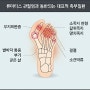 류마티스로 변형된 발, 때 놓치지 않고 수술해야