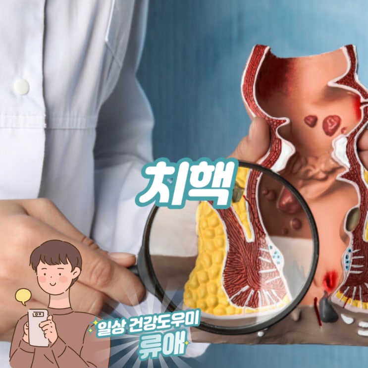 치핵 증상 및 원인, 치핵 자연치료 : 치핵 1기 - 4기 유형과 관리 팁 : 네이버 블로그