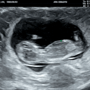 [축복일기] 임신6주~11주차 / 증상, 초음파, 성별추측