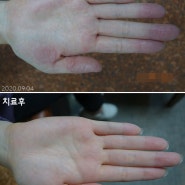 손 주부습진 증상 피부면역 치료가 효과적