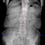 Lumbar lordotic curve, Pelvic In Ex