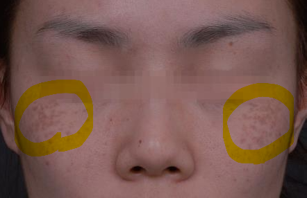 기미가 아닌, ABNOM(애브넘, 후천성양측성 오타모반양 반) : 네이버 블로그