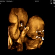 임신일기 #32, 동국대 일산병원 임신 23주5일 /입체초음파