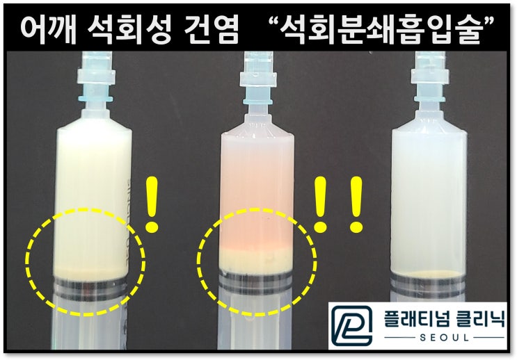 (플래티넘의원) 어깨 석회성 검염. 이런 치료가 가능하다고?