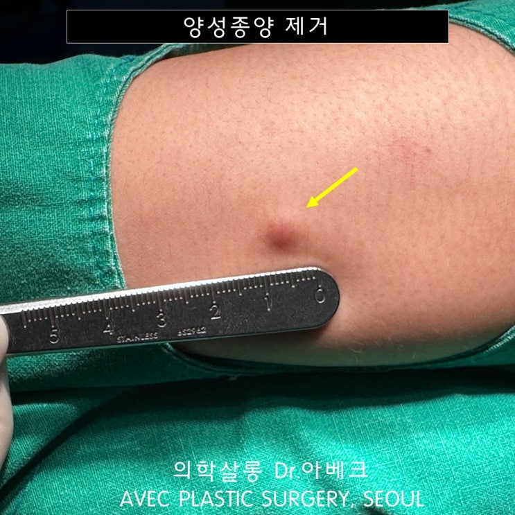 팔뚝 피부섬유종 제거 후기 【Dr. 아베크 양성종양】 : 네이버 블로그