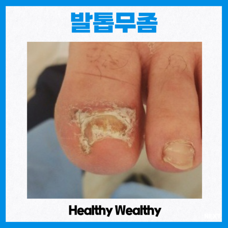 발톱 무좀 초기 증상 및 원인은? 약 치료 엄지발가락 무좀 가려움 : 네이버 블로그
