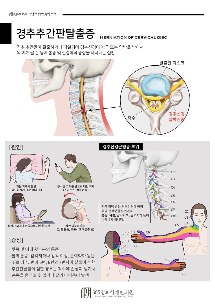 경추 추간판 탈출증이란? : 네이버 블로그