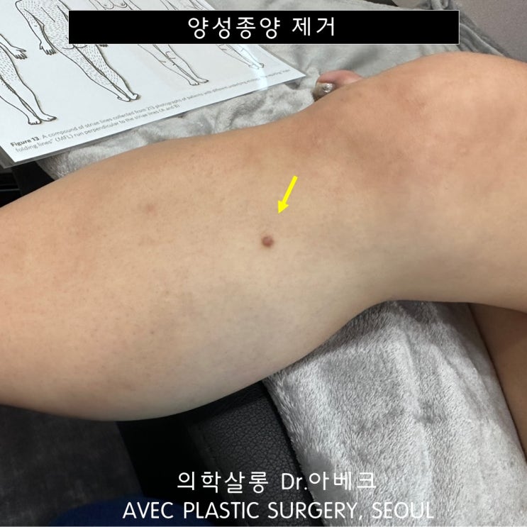 종아리 피부섬유종 제거 사례 【Dr. 아베크 양성종양】 : 네이버 블로그