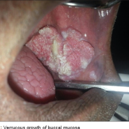 Verrucous Carcinoma 사마귀모양암 / 우췌성암
