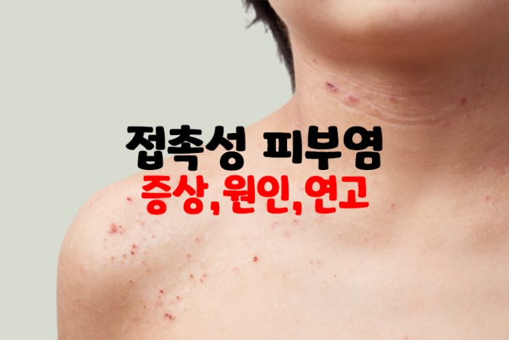 접촉성 피부염 수포 증상 원인 약 연고 : 네이버 블로그