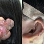 [켈로이드 수술]리뉴미피부과 동대문점 귀 켈로이드 수술