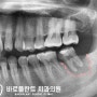 "왼쪽 아래 어금니가 부러졌어요!" 부러진 치아, 해결할 수 있는 방법은? 구리 치과 발치와 보존술 동반한 임플란트 수술 과정
