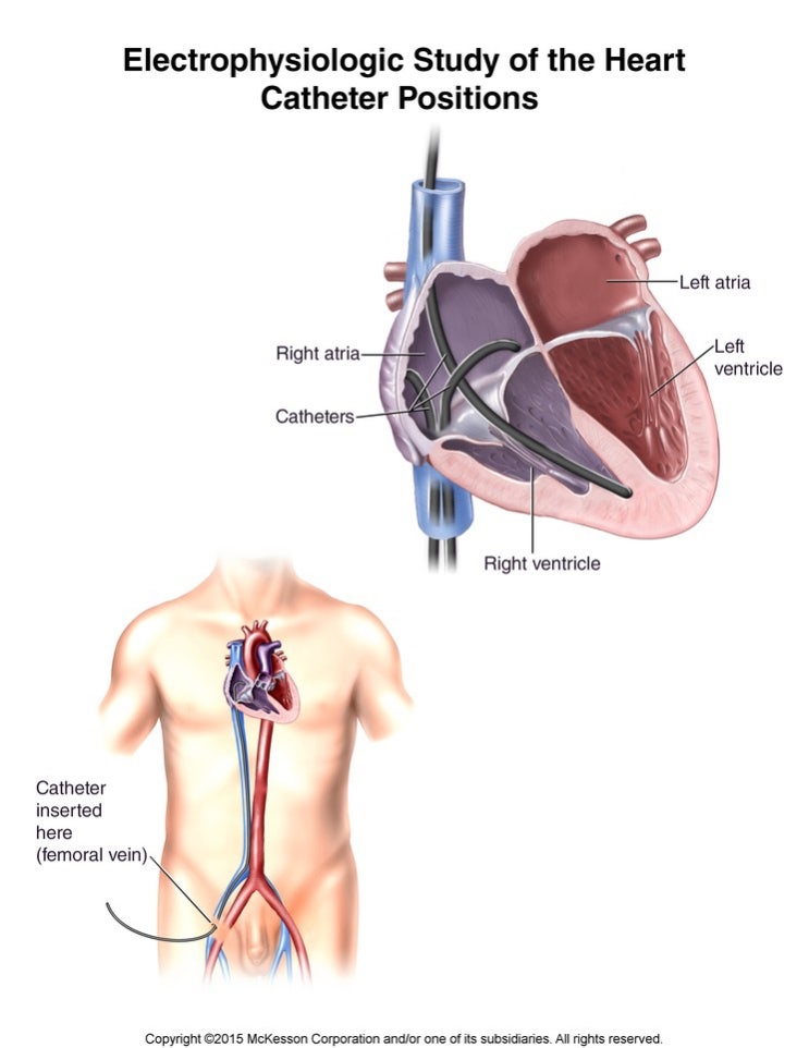부정맥 치료 RFA(고주파 전극도자 절제술), EPS(Electrophysiologic Study,심장 전기 생리학 검사) 검사 ...