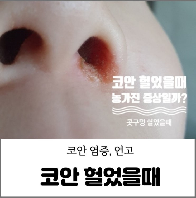 코안 콧구멍 헐었을때 염증 고름냄새 어떤 연고를 바를까 : 네이버 블로그