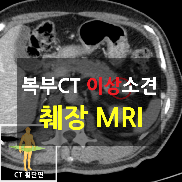 췌장CT 병변 발견 후, 췌장MRI 검사가 진행된 진단사례 : 네이버 블로그