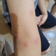 어린이 초등학생 모기 벌레물림 두드러기 알레르기 증상