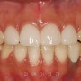앞니 이맥스 라미네이트 (eMax Laminate crowns on upper anterior teeth)