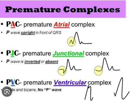 PVC / PAC / PJC / non - sustained VT : 네이버 블로그
