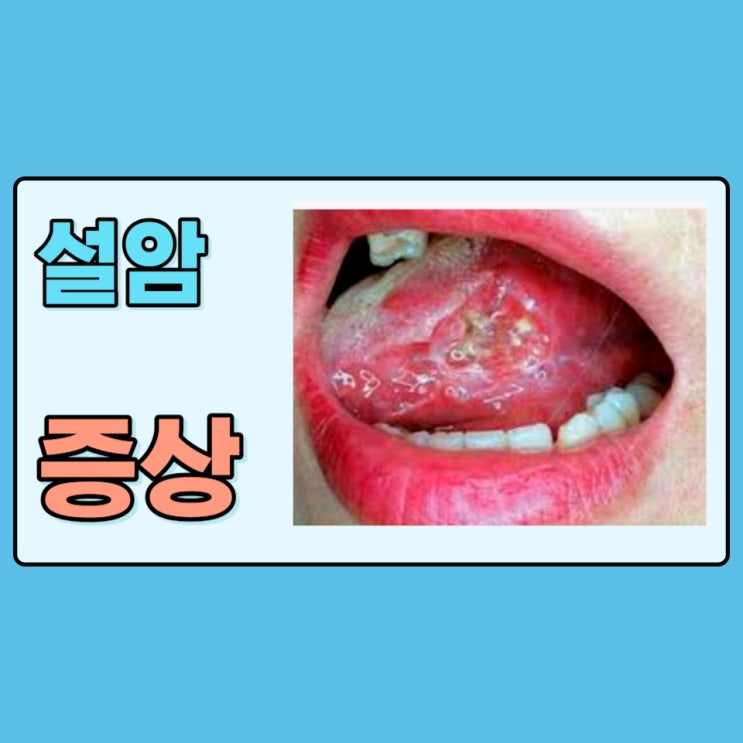 설암 초기증상 설암원인 구강암 혀암 예방법 : 네이버 블로그