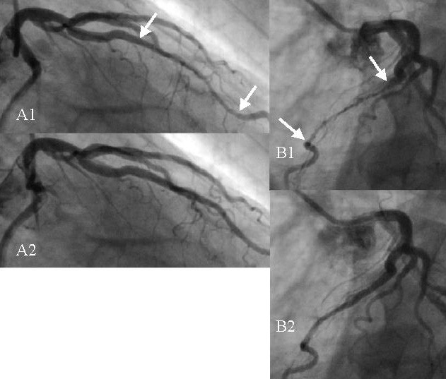 Myocardial Bridge : 네이버 블로그