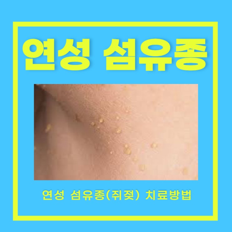 목 쥐젖 제거 비용 쥐젖 제거 쥐젖 원인 : 네이버 블로그