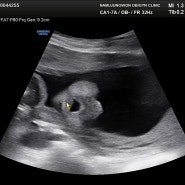 자궁경부무력증 임신 24주차 우동이 기록 정밀초음파 실패