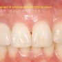 치아 미백을 동반한 앞니 지르코니아 크라운 치료 (Zirconia crown restoration & tooth whitening in upper anterior tooth)