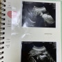 쌍둥이 임신) 26~29주 태동, 임산부 눕는 자세