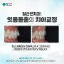 일산치과 치아교정후기, 일산연치과의 잇몸돌출 치아교정