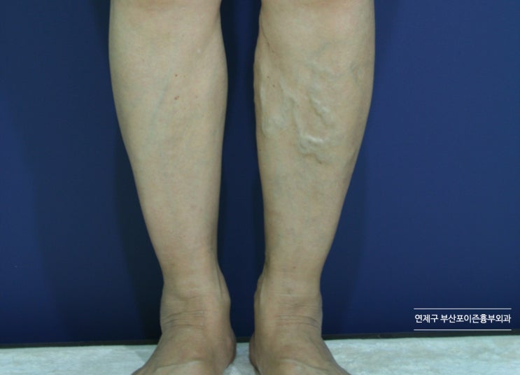 한쪽다리부종 갑자기? 만성적? (+한쪽하지정맥류?) : 네이버 블로그