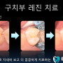 충치치료 - 인레이 Vs 레진