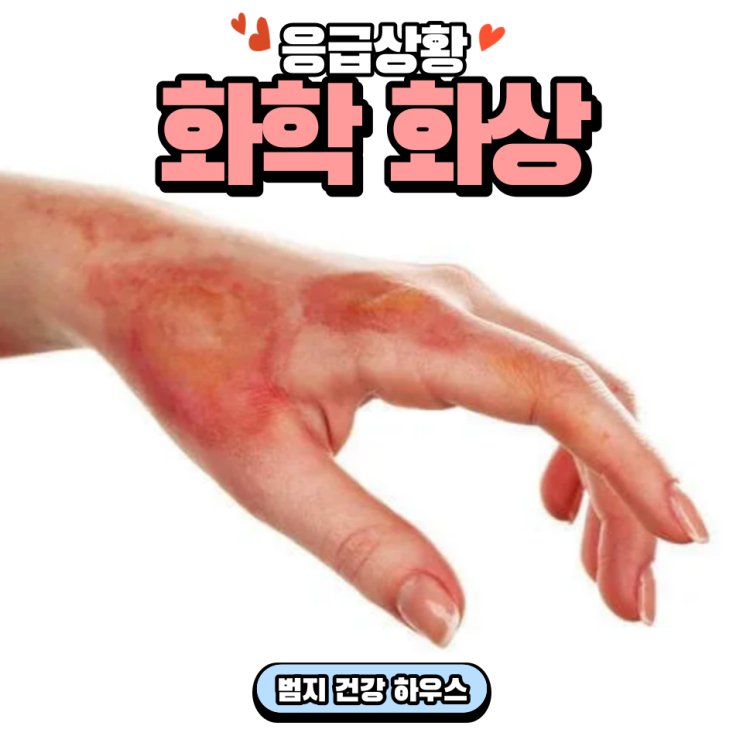화학 화상 응급처치 : 화학 물질 안전 사고 응급 상황 : 네이버 블로그