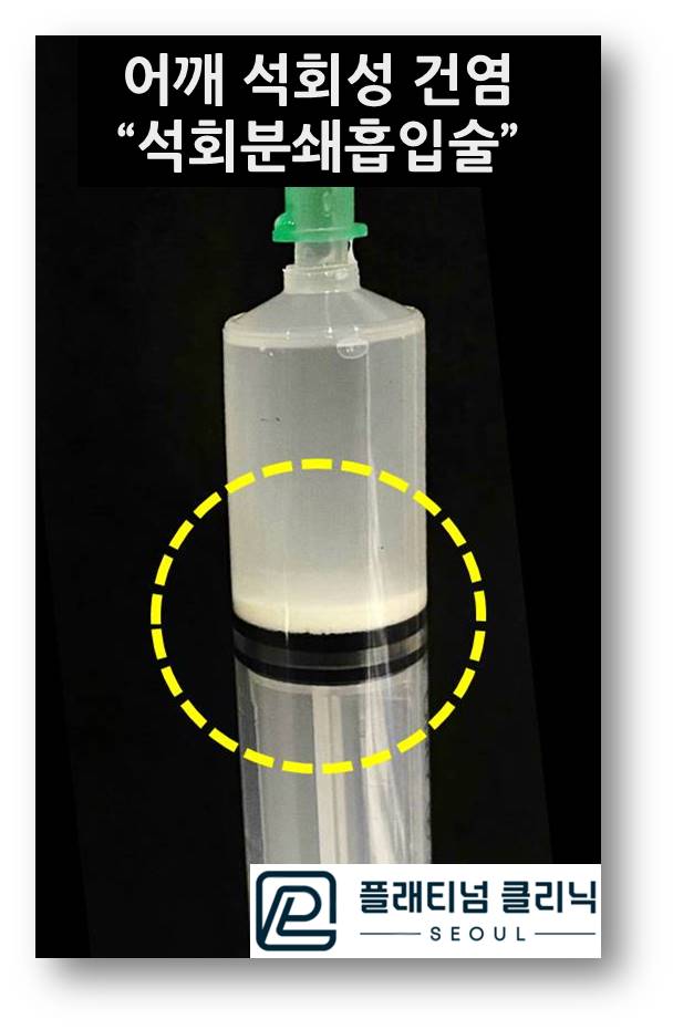 (플래티넘의원)석회성건염의 근본적치료. 비수술적으로 치료할 수 있습니다.