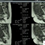 자궁근종 출혈 증상 폐경기 MRI 확인해보면