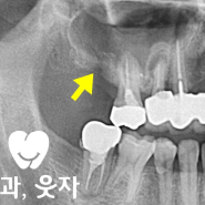 임플란트 실패 그리고 빠른 후속 조치법