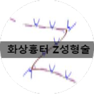 [부산 성가병원] 화상 흉터 환자분의 Z성형술 사례입니다.